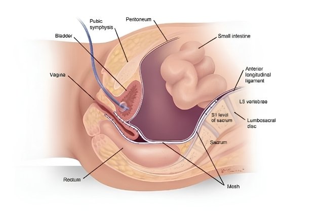 Vaginal Prolapse